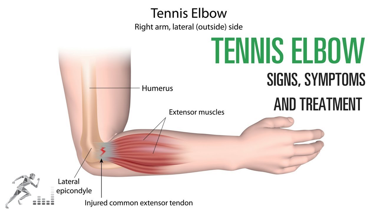 what is tennis elbow